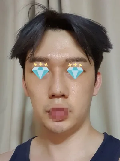 鼻整形、大成功したみたいですww