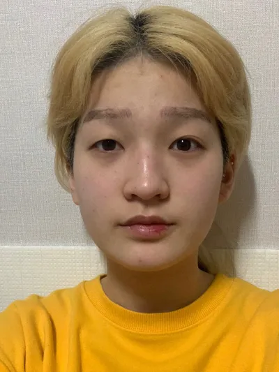 手術して4ヶ月、メイクがいりません！！