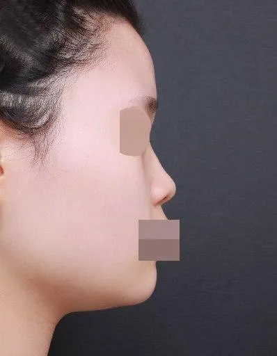 鼻の手術から1ヶ月経ったレビューです。