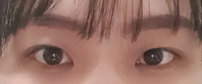 1ヶ月でこんなに自然になって、とても満足しています！笑