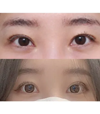 手術してから一ヶ月ちょっと過ぎました。