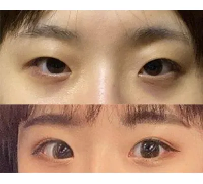 もともと目は重たく見えていたのですが、確実に本当に重たい感じがなくなりました。本当に満足しています！！