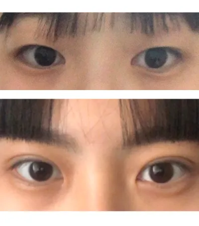 術後の写真は、二重整形をしてから38日ほど経過した目です！