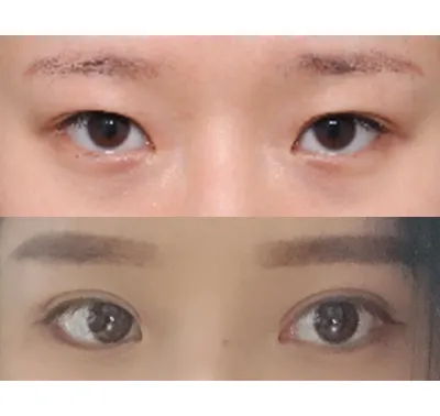 以前、切開法で二重にしたのですが、だんだん二重の幅が狭くなっていくのがずっとストレスだったので、再手術を選びました。