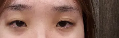 ベリーグッド美容外科で初めての目の整形を受けました。