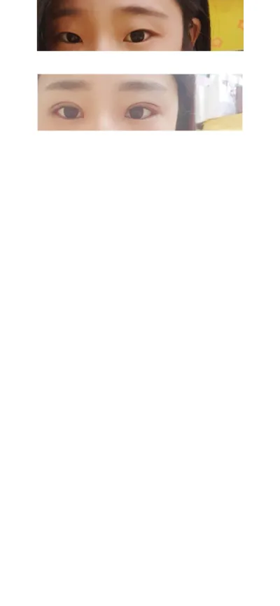 私は二重、自然癒着、目頭切開、目尻切開をしました~~^^