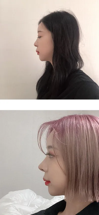 鼻整形6ヶ月目のレビューです。