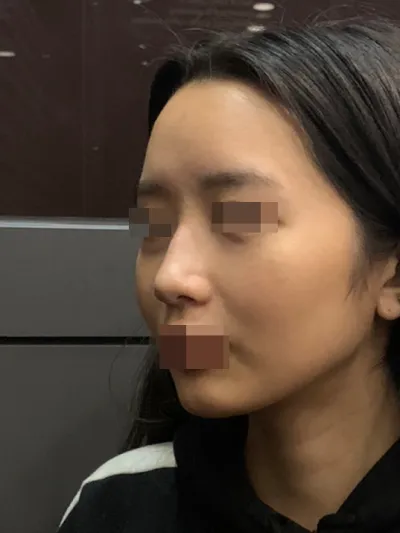 ベリーグッドで初めて鼻の整形をしました！ベリーグッド！