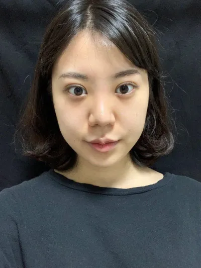 時間が経って腫れもすっかり引き、自然で違和感なく馴染んだので、とても嬉しいです。ベリー・グッド〜！！