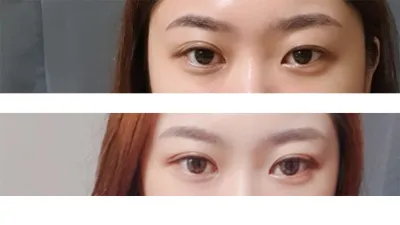 ベリーグッドで初めて二重整形をしてから3ヶ月ほど経ちました。レポを残します〜