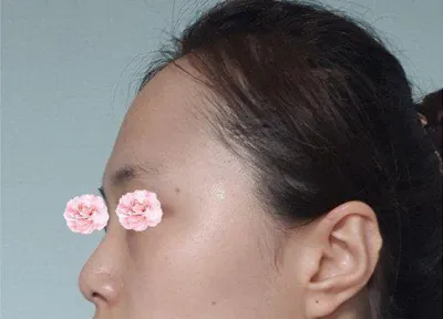 室長も院長もとても親切で、鼻筋も鼻先も気に入っています！！