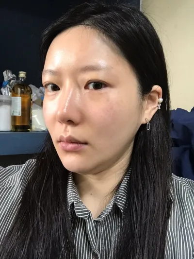 顎下の脂肪吸引だけするつもりでしたが、エラスティクムとミント糸を組み合わせて受けたら、本当に満足しています！レビューを残します。