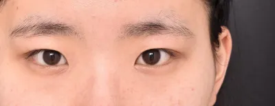 二重整形してから、いつの間にかもう4ヶ月目です'ㅜ'!!!