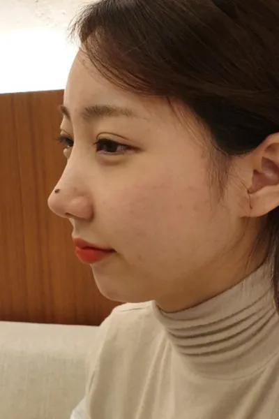 顎がない感じだったので、顎先手術をしました！！