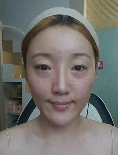 二重、目の下の脂肪再配置、輪郭3点 3ヶ月後のレポです。