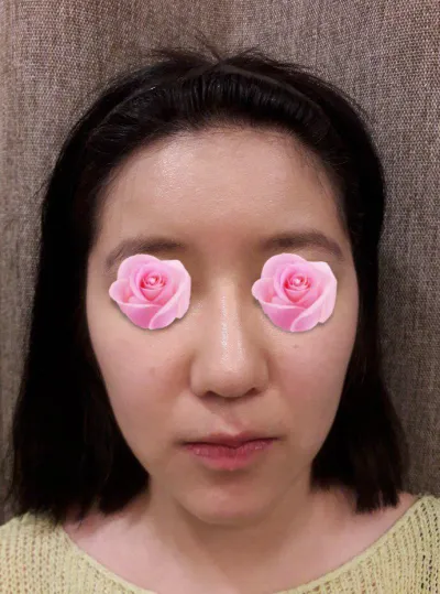 手術して2ヶ月経ちましたぁ。鼻の再手術、輪郭、頬骨、長曲線、顎先をしましたぁ。