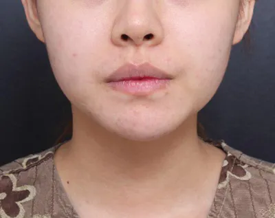 顔の脂肪吸引から1ヶ月ほど経ちましたが、フェイスラインもかなり整ってきて、とても満足しています！