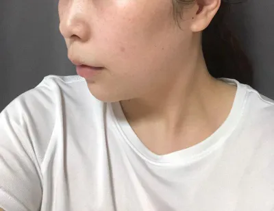 二重あご、フェイスラインの顔の脂肪吸引をして1ヶ月後のレポです〜