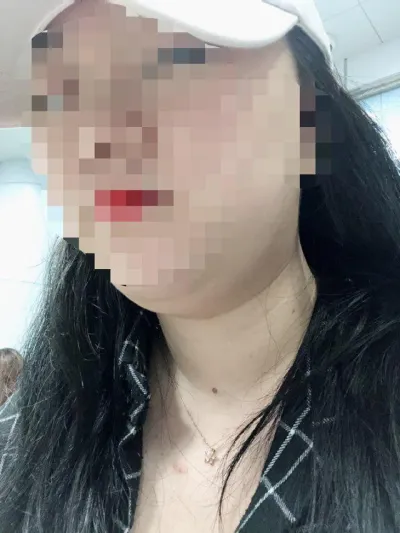 二重あごでずっと悩んでいましたが、顔の脂肪吸引を受けました。