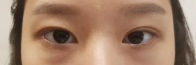 手術からほぼ3ヶ月後の写真です~~ レポ残します!!~