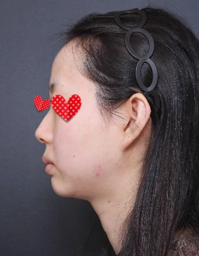 鼻、脂肪移植3週目ですが、団子鼻、鷲鼻、額のへこみ、顎のせいで感じていたストレスがすっかり消えました。