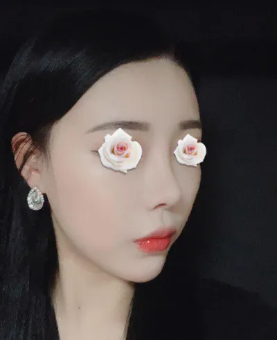 イム・ヨンミン院長に鼻整形を受けてから1ヶ月目です。