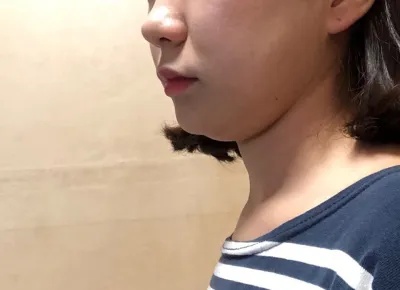 二重顎の脂肪吸引、新世界です..bb