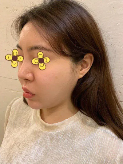 糸リフトしてよかったです😭