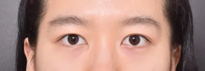 目の再手術、成功しました😭