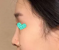 鼻の手術をしてから63日経ちました〜