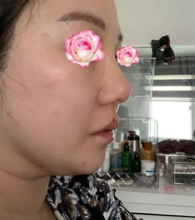 ベリーグッド整形外科で鼻整形しました。