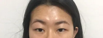 ベリーグッド美容外科のキム・ジュンヒョン院長に、額リフトと埋没目つき矯正を受けました。