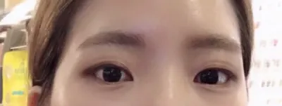 切開法で二重整形をしてから5〜6週間ほど経ったレポですwww