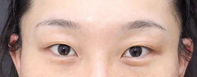 皆さん、二重整形はベリーグッド整形外科でしてくださいㅠㅠ！！！