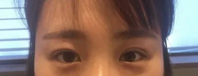 目の整形後12日目のレポです〜