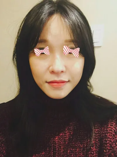 顔の自家脂肪移植！