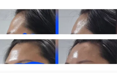 [차**様] 額フィラー施術レビュー