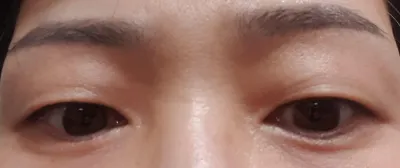 目の手術体験談