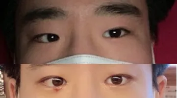 目の手術体験談