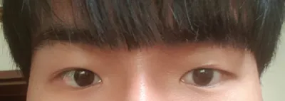 目の再手術体験記