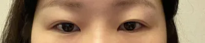目・鼻 再手術の手術体験談