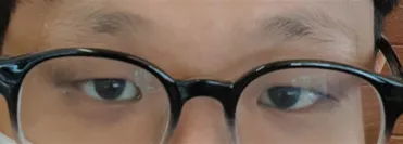 目の手術体験談