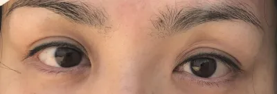 目の手術体験談