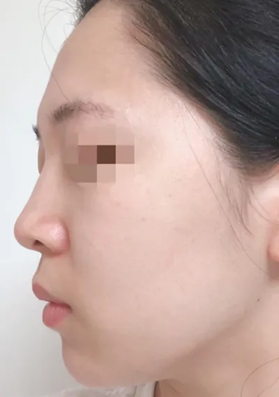 脂肪 | その他 手術体験談