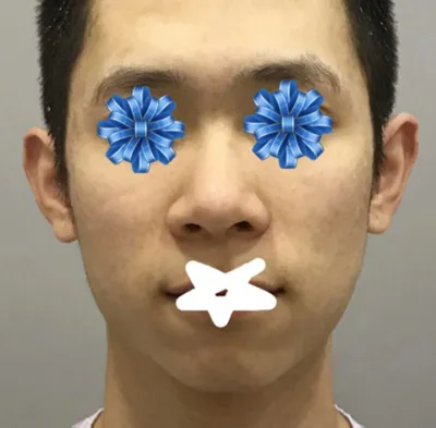 鼻 | 輪郭手術レポ