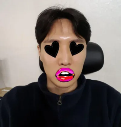 鼻再手術 | リフティング手術レポ