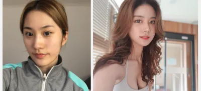 目、鼻、輪郭、フルフェイス脂肪移植、唇フィラー