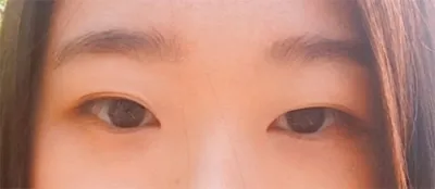 切らない埋没法二重手術のレビュー！