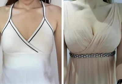 豊胸手術のレビューです～