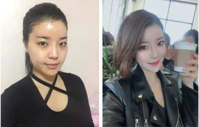 ジェイジュンで輪郭4種を受けました～